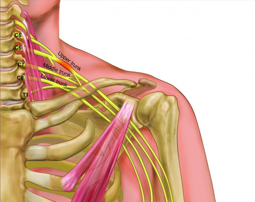 Principais vantagens da cirurgia para plexo braquial